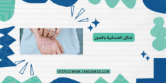 شكل الصدفية بالصور
