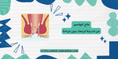 علاج البواسير من الدرجة الرابعة بدون جراحة