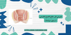 تجربتي فى علاج الشرخ الشرجي ( بدون جراحة )
