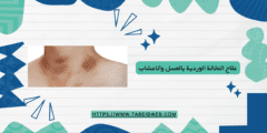 علاج النخالة الوردية بالعسل والاعشاب