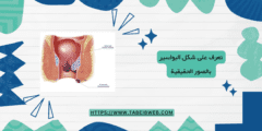 تعرف على شكل البواسير بالصور الحقيقية