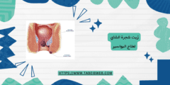زيت شجرة الشاي لعلاج البواسير