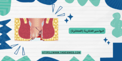 البواسير الخثارية (المتخثرة) الأسباب والعلاج