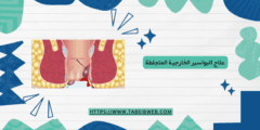 علاج البواسير الخارجية المتجلطة