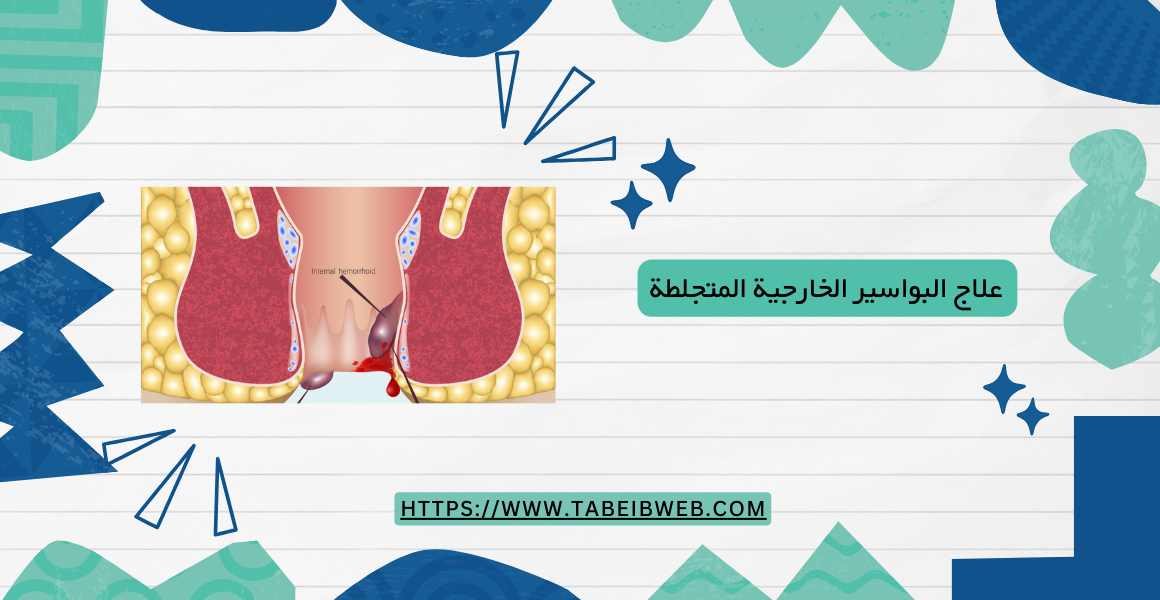 علاج البواسير الخارجية المتجلطة