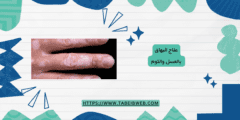 علاج البهاق بالعسل والثوم