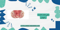 ماهي علامات الاصابة ب البواسير