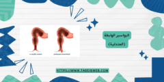 البواسير الهابطة (المتدلية) الأسباب والعلاج
