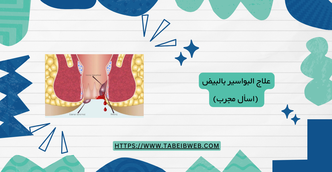 علاج البواسير بالبيض (اسأل مجرب) 1 طبيب ويب علاج البواسير بالبيض