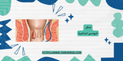 تعرف على شكل البواسير الداخلية بالصور الحقيقية