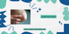 علاج الصدفية بالفازلين