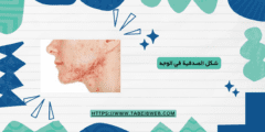 شكل الصدفية في الوجه
