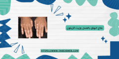 علاج البهاق بالعسل وزيت الزيتون