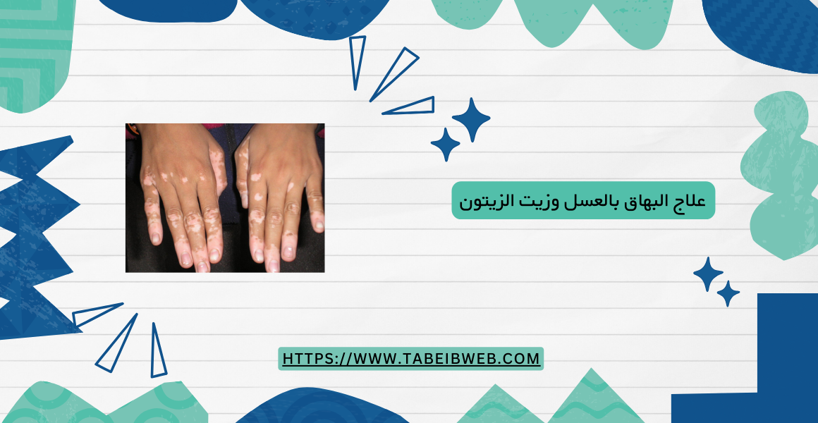 علاج البهاق بالعسل وزيت الزيتون