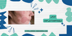 اعراض جرثومة المعدة على الجلد
