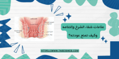 علامات شفاء الشرخ وإلتئامه، وكيف تمنع عودته؟