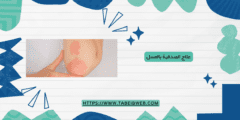 علاج الصدفية بالعسل