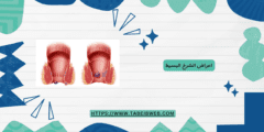 اعراض الشرخ البسيط