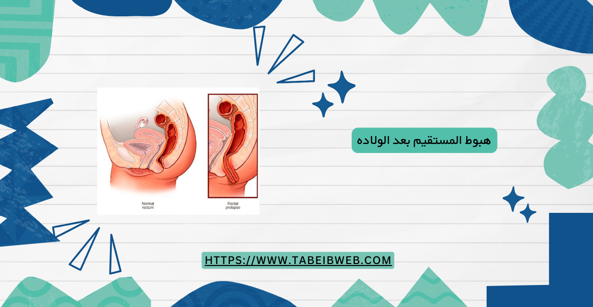 هبوط المستقيم بعد الولاده 1 طبيب ويب هبوط المستقيم بعد الولاده