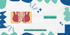 علاج البواسير بالثوم