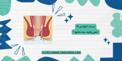 درجات البواسير 4| ماهي وكيف يتم علاجها ؟