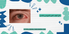 علاج التهاب العين الفيروسي بالعسل