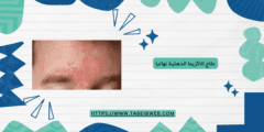علاج الاكزيما الدهنية نهائيا