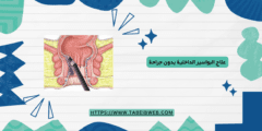 علاج البواسير الداخلية بدون جراحة