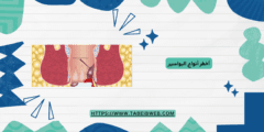 أخطر أنواع البواسير
