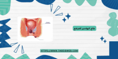 علاج البواسير للمرضع