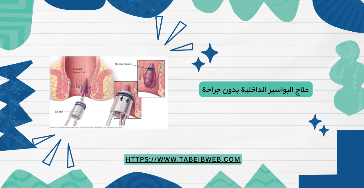 علاج البواسير الداخلية بدون جراحة