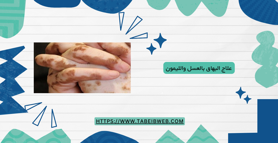 علاج البهاق بالعسل والليمون