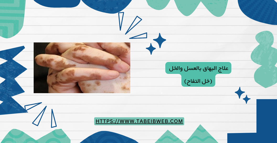 علاج البهاق بالعسل والخل (خل التفاح)