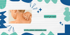 كيفية علاج الحصبة
