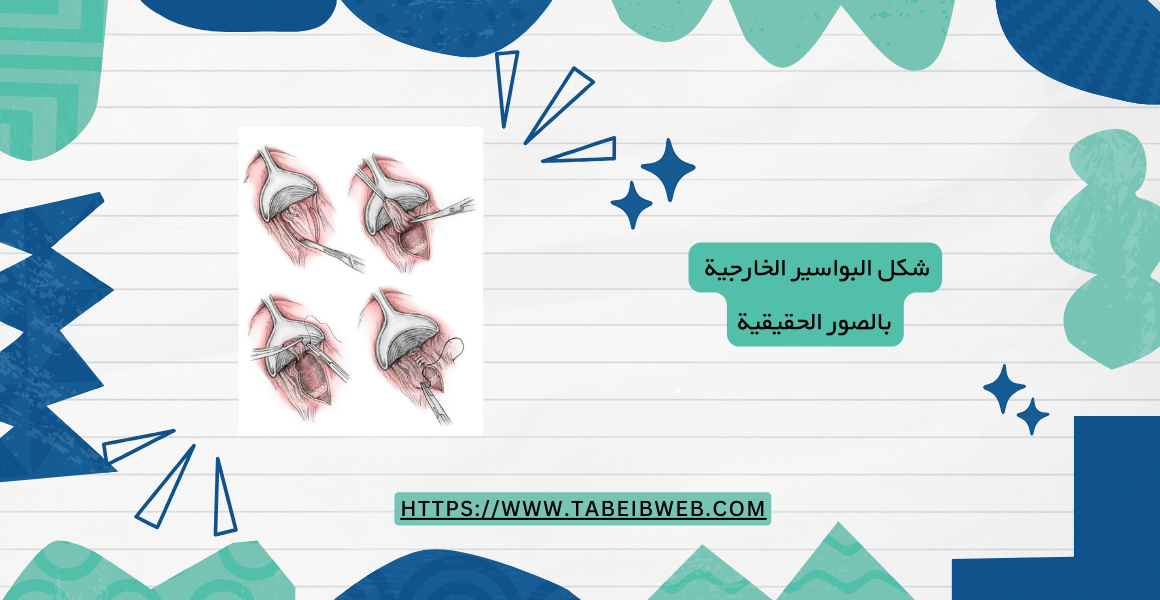 شكل البواسير الخارجية