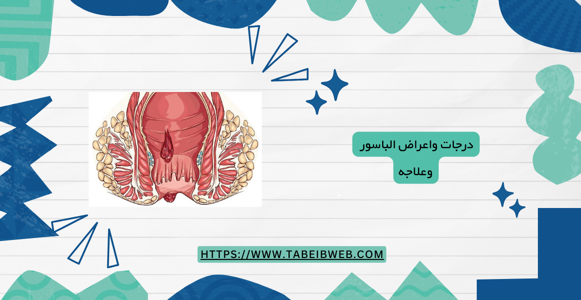 درجات واعراض الباسور وعلاجه
