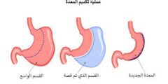 عملية تكميم المعدة في مصر: كل ما تحتاج معرفته قبل اتخاذ القرار